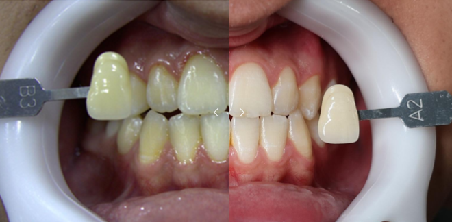 Rizzo White Kit Clareador Dental