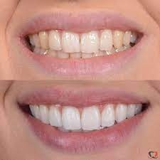 Rizzo White Kit Clareador Dental