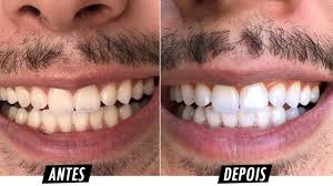 Rizzo White Kit Clareador Dental