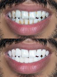 Rizzo White Kit Clareador Dental