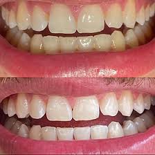 Rizzo White Kit Clareador Dental