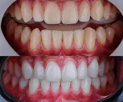 Rizzo White Kit Clareador Dental